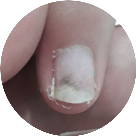 fungo_descolamento_infiltracao_alongamento de unha de gel ficha anamnese importante Nail designer 5