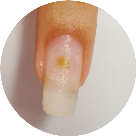 fungo_descolamento_infiltracao_alongamento de unha de gel ficha anamnese importante Nail designer 6