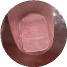 fungo_descolamento_infiltracao_alongamento de unha de gel ficha anamnese importante Nail designer 7